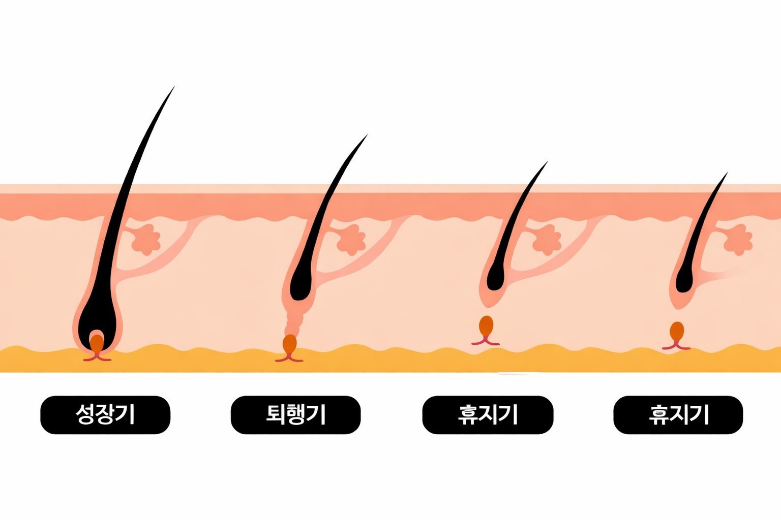 겨드랑이 레이저 제모 시기