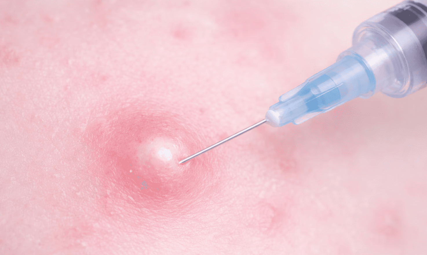 여드름 염증주사 효과 극대화 시키는 법