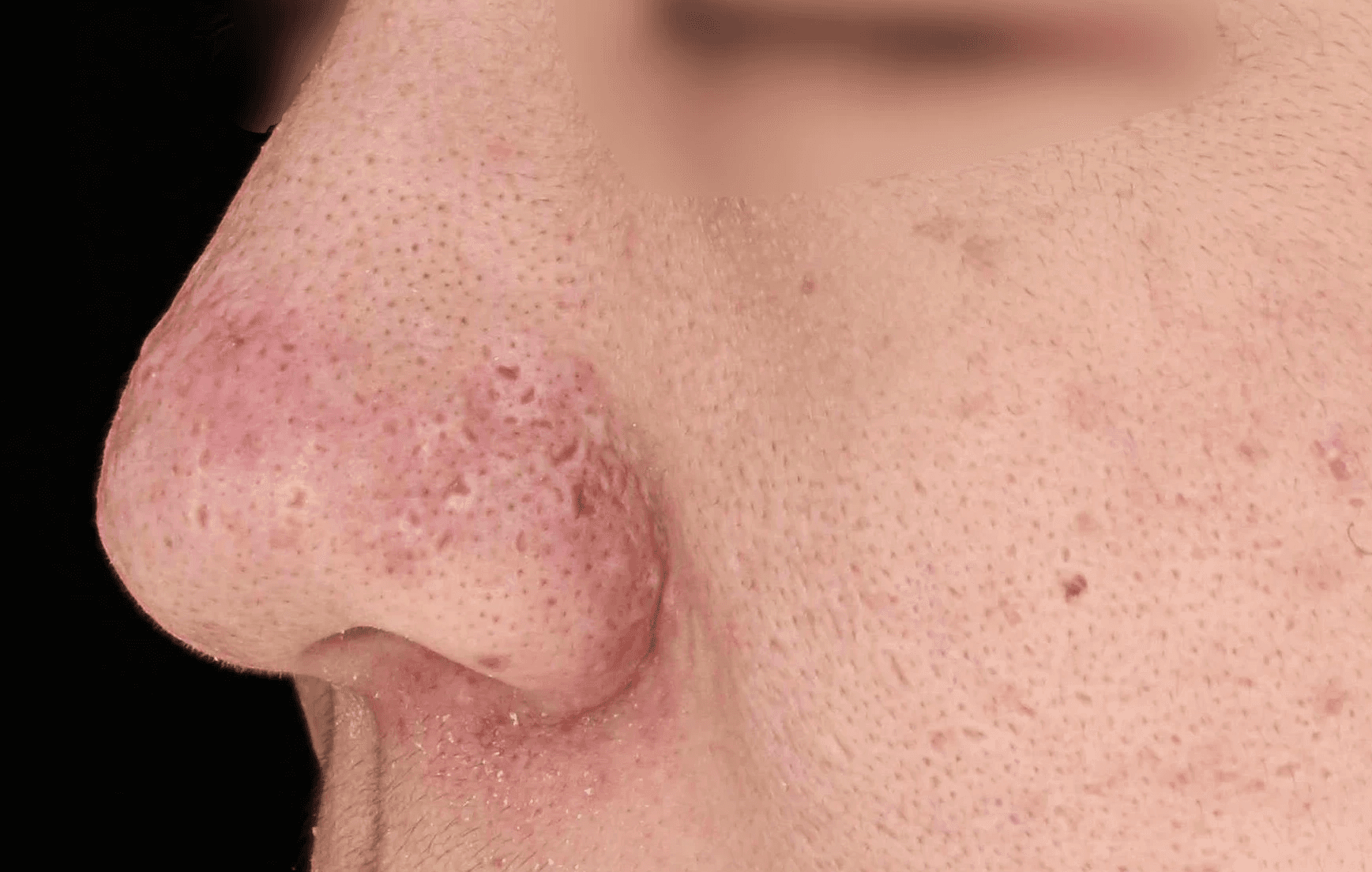 秘密雷射改善臉部毛孔收縮效果