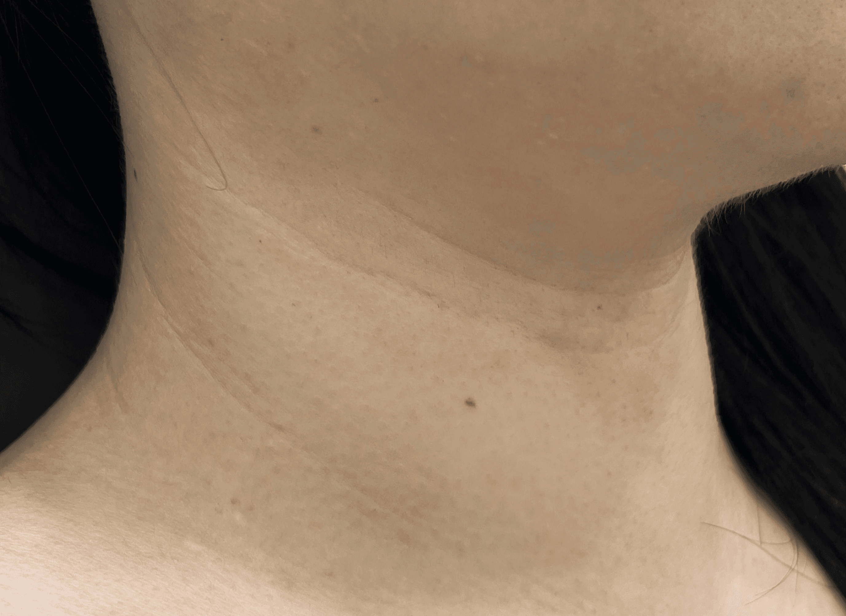 頸紋填充劑1CC 使用貝洛特羅Revive的原因