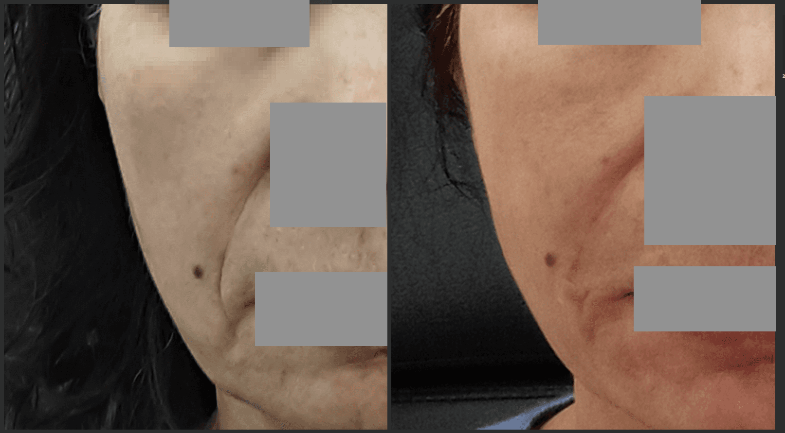 레디어스 도대체 뭘까? 부작용과 효과