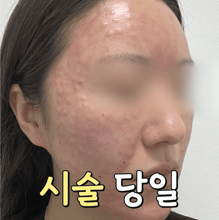 리쥬란 HB 1주간 변화