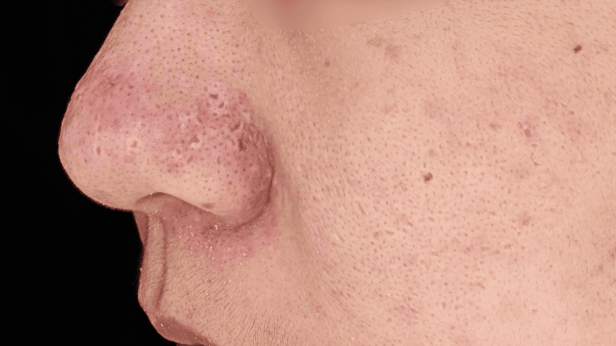 모공축소 효과적인 방법