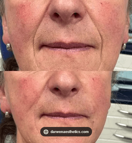 볼꺼짐 걱정 없는 남자 울쎄라 시술법, 여성과 시술 방식이 달라야 하는 이유