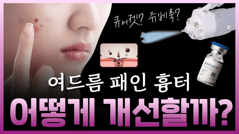 การปรับปรุงรอยแผลเป็นจากสิวด้วยเคอร์เจ็ต