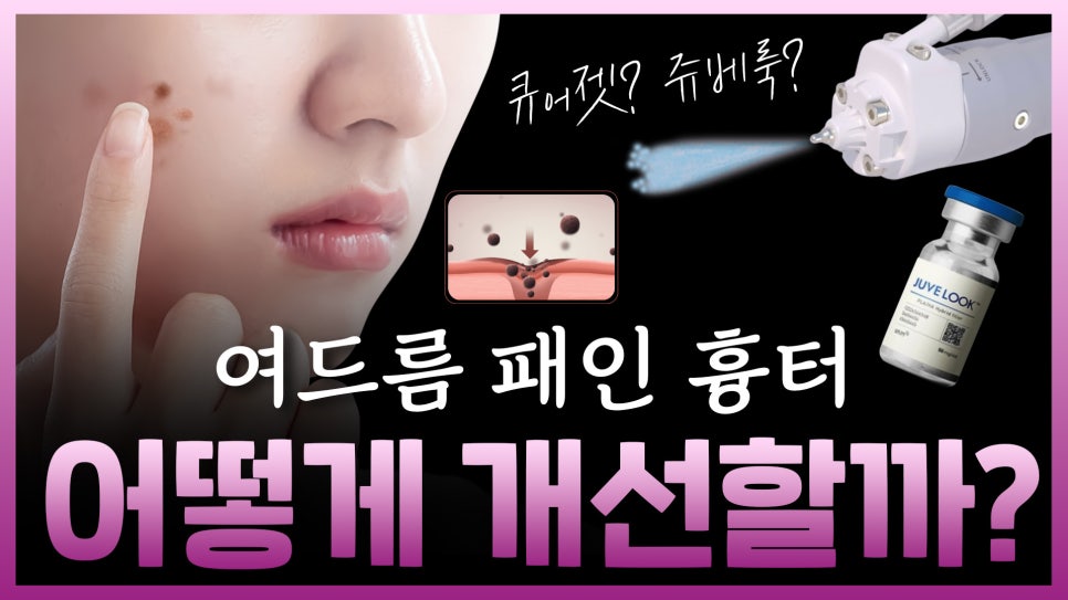 큐어젯 쥬베룩으로 여드름 흉터개선