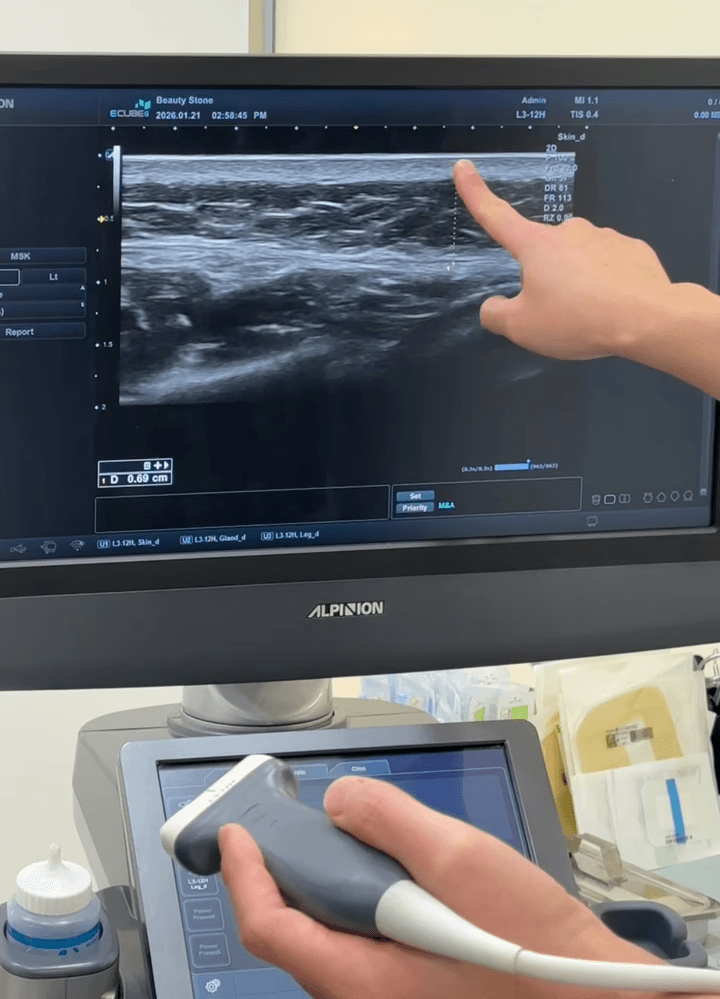 비싼 초음파기계로 피부두께를 재는 이유