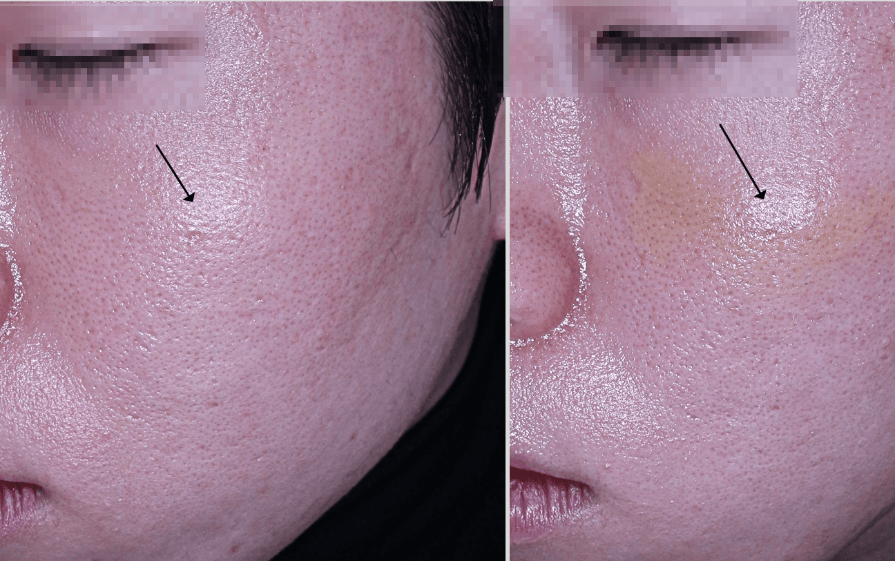 리투오시술후개선된잔주름