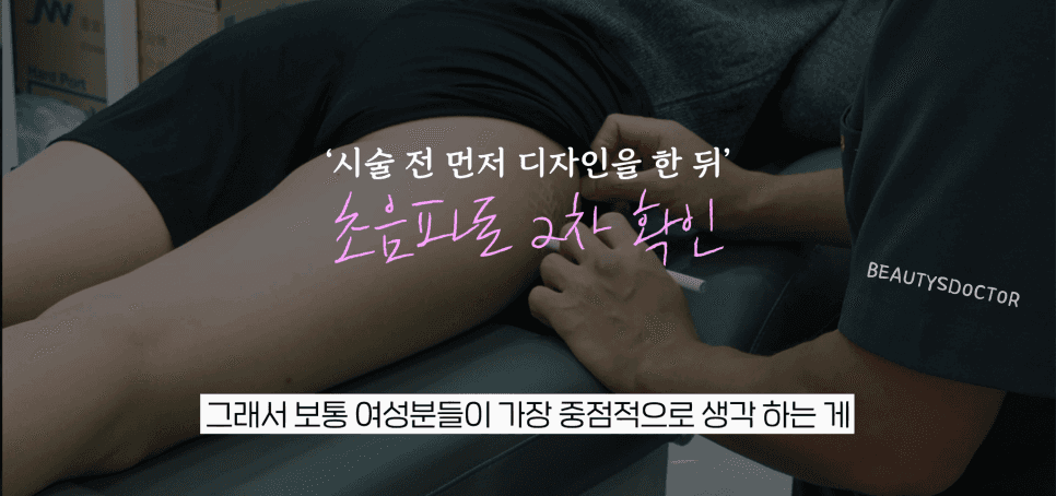전종서 골반 필러, 효과와 부작용