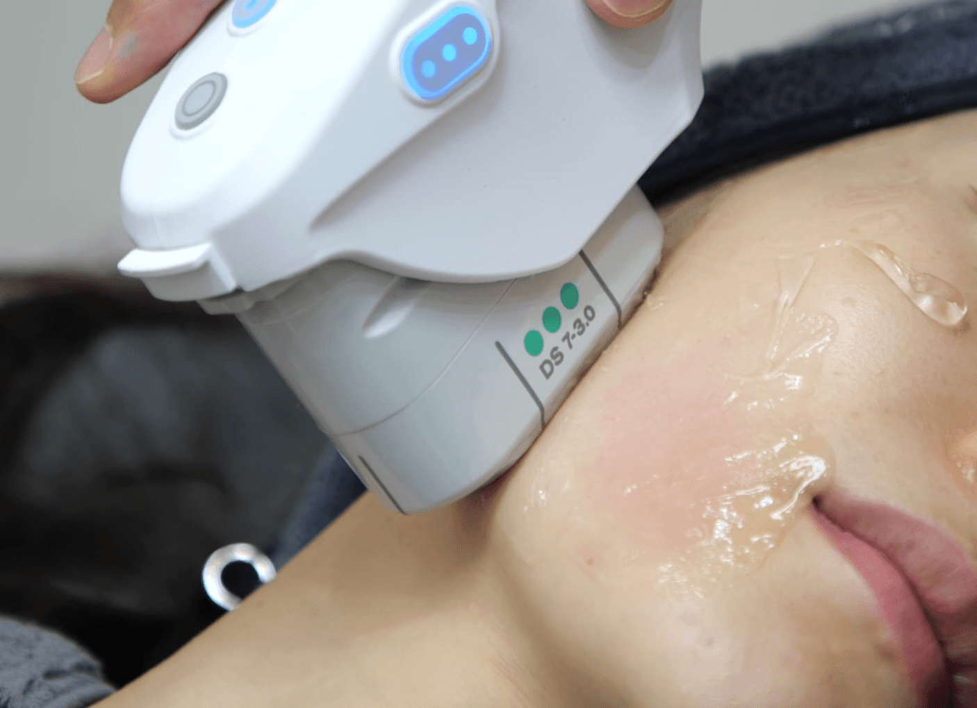 볼꺼짐 걱정 없는 남자 울쎄라 시술법, 여성과 시술 방식이 달라야 하는 이유