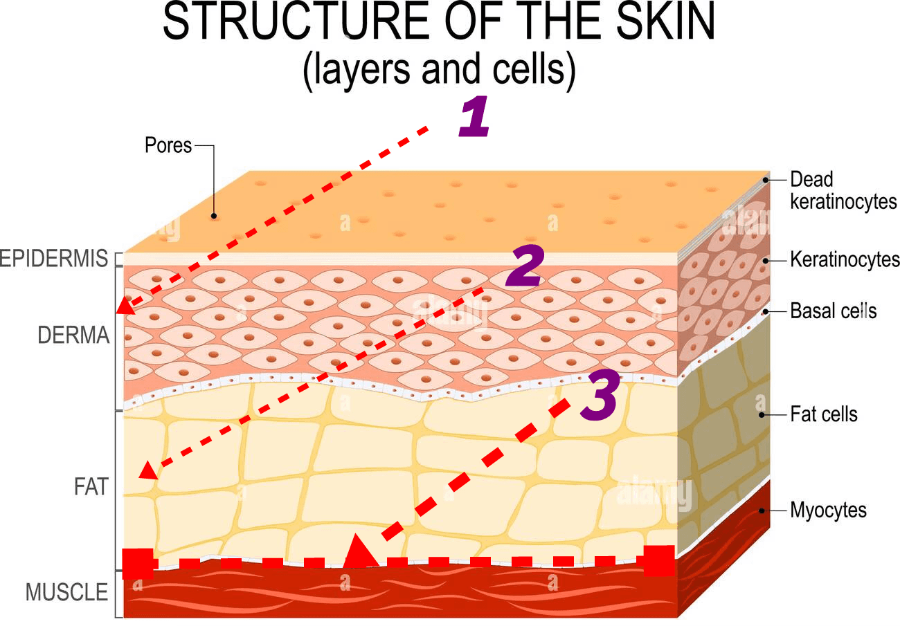 볼꺼짐 걱정 없는 남자 울쎄라 시술법, 여성과 시술 방식이 달라야 하는 이유