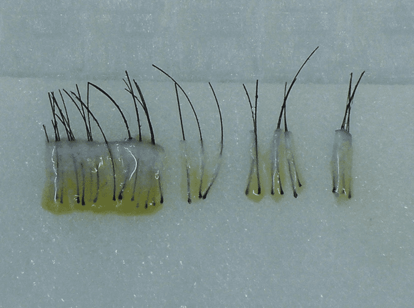 남자제모는어렵습니다.뷰티스톤의원 | 홍대피부과