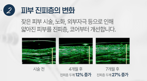 레디어스 도대체 뭘까? 부작용과 효과