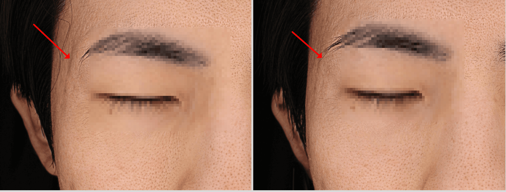 Cellredm vs Retuo，哪款皮肤水光更適合我？（價格、疼痛、效果比較）