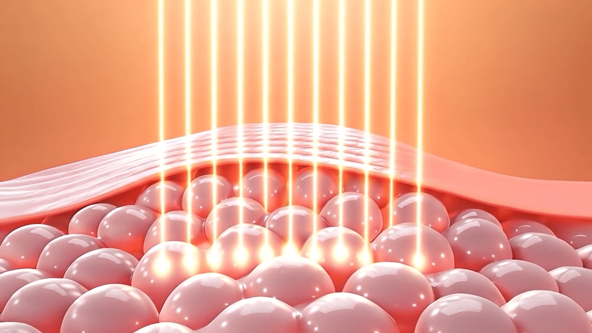 울쎄라피프라임 받고 후회하는 이유, 남자와 여자차이
