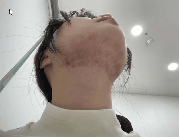 인모드 시술 부위 얼굴 턱선 이중턱 복부 타이트닝