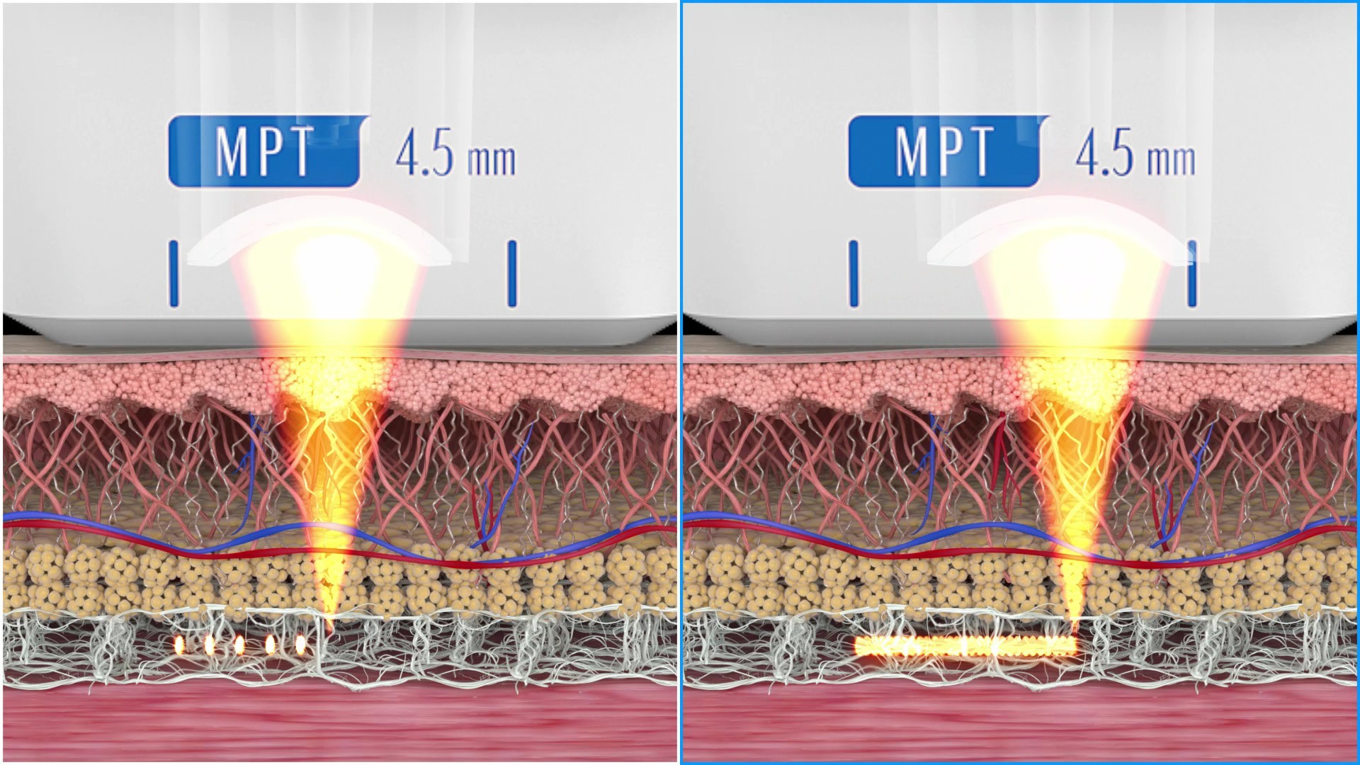 การเปรียบเทียบผลของシュリングユニバース 300 ช็อต กับ 600 ช็อต