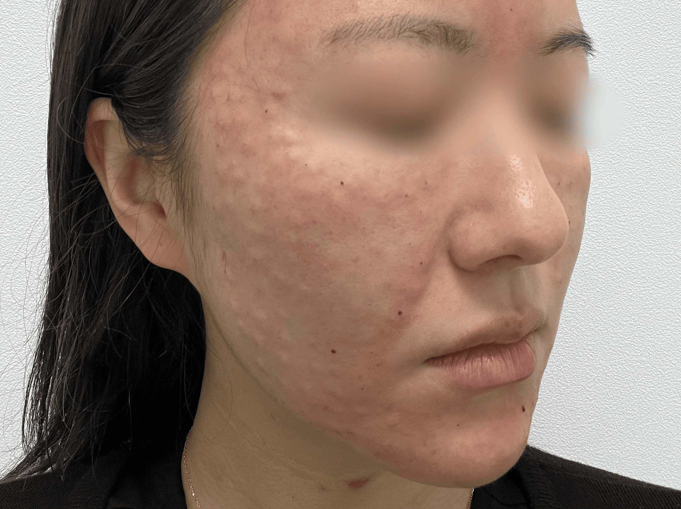 스킨바이브,쥬베룩,리쥬란,리바이브 정리