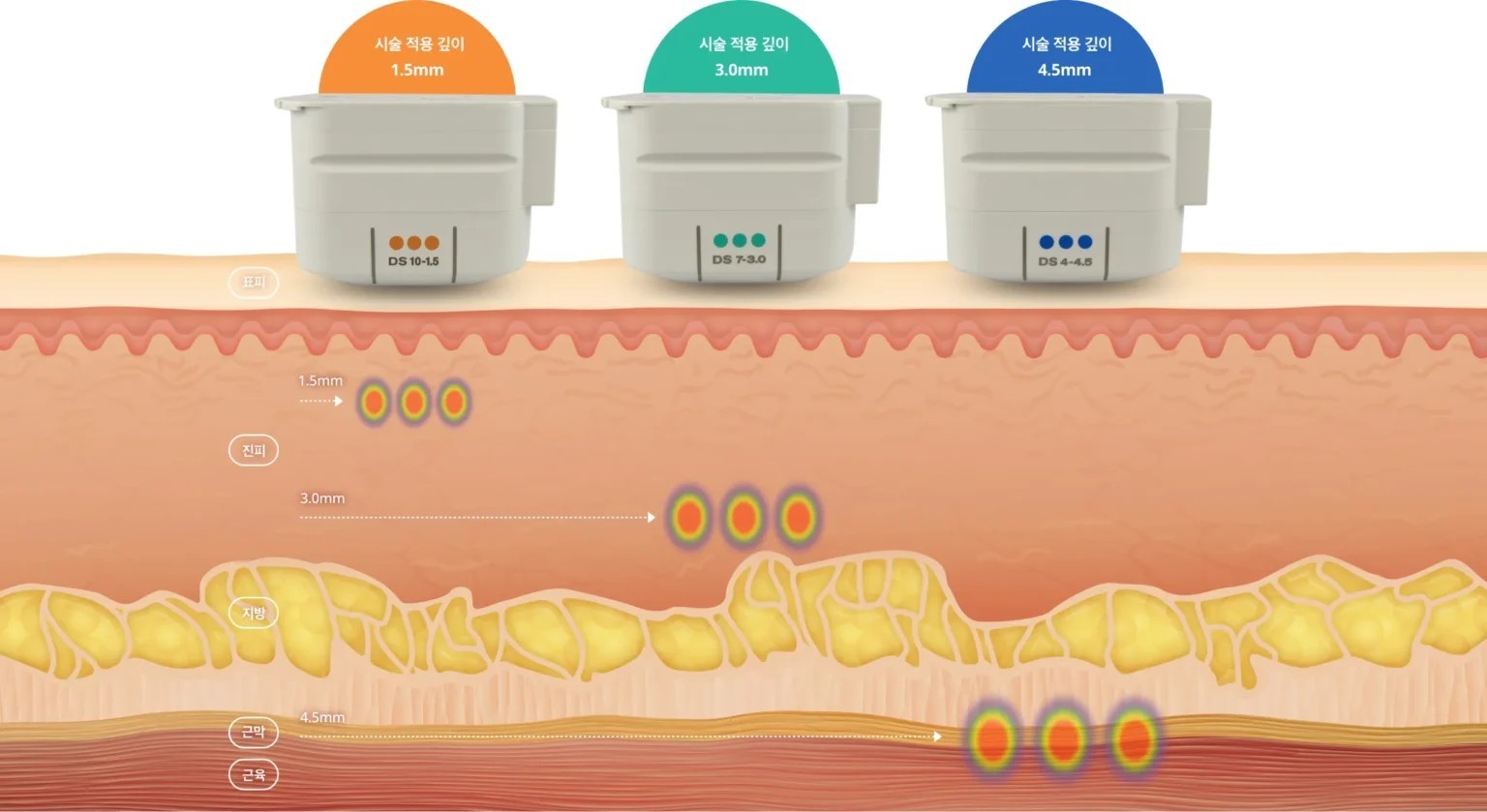 슈링크 효과 시기, 300샷과 같이 알아보기