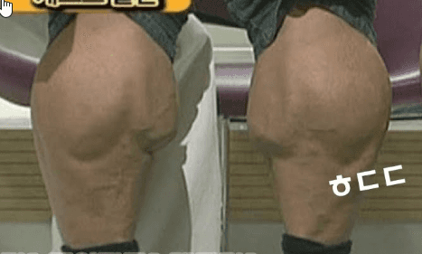 종아리 보톡스 후 효과와 주기, 종아리보톡스후기