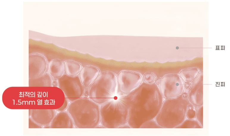 Who Benefits Most from Sofwave? Sofwave with No Worry About Cheek Volume Loss