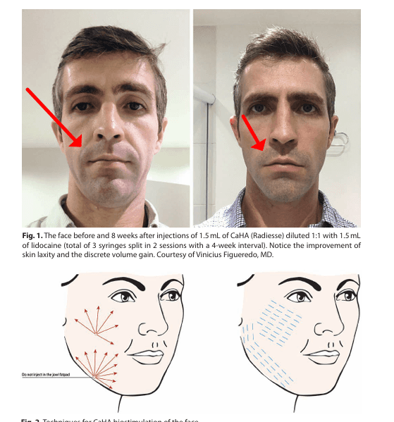 레디어스 도대체 뭘까? 부작용과 효과