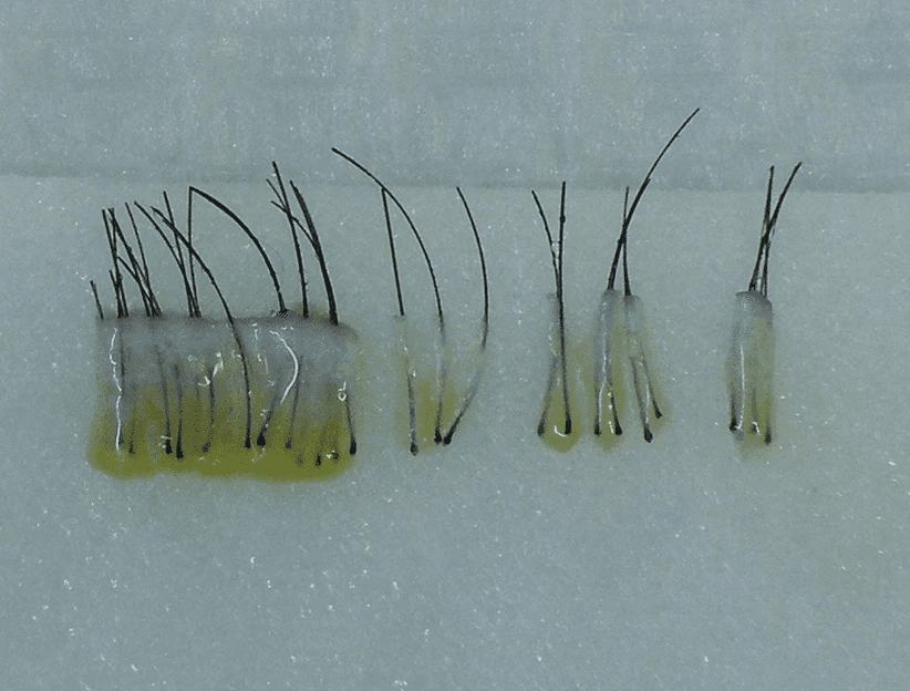 Gentle Max Pro คลินิกผิวหนังกรุงโซล