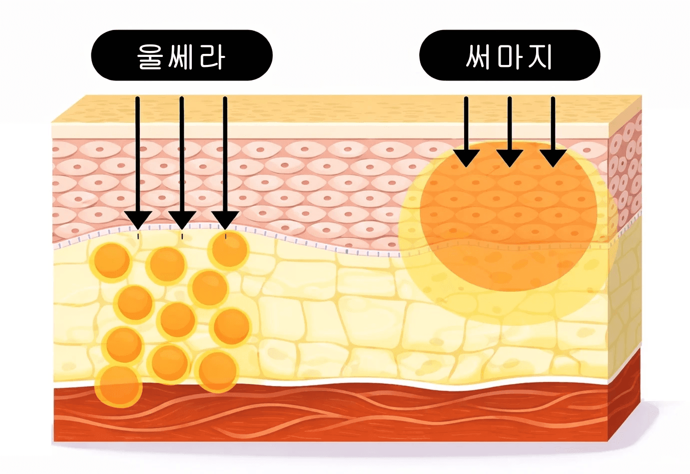 熱玛吉FLX效果、持續時間，300發夠用嗎？