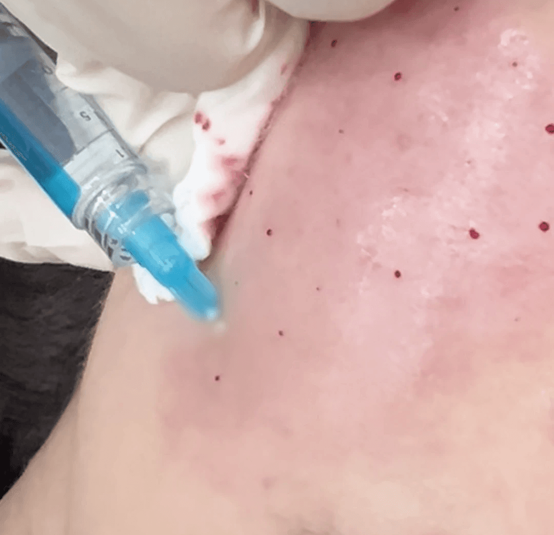 วิธีเพิ่มประสิทธิภาพการรักษาสิวด้วยการฉีดยา