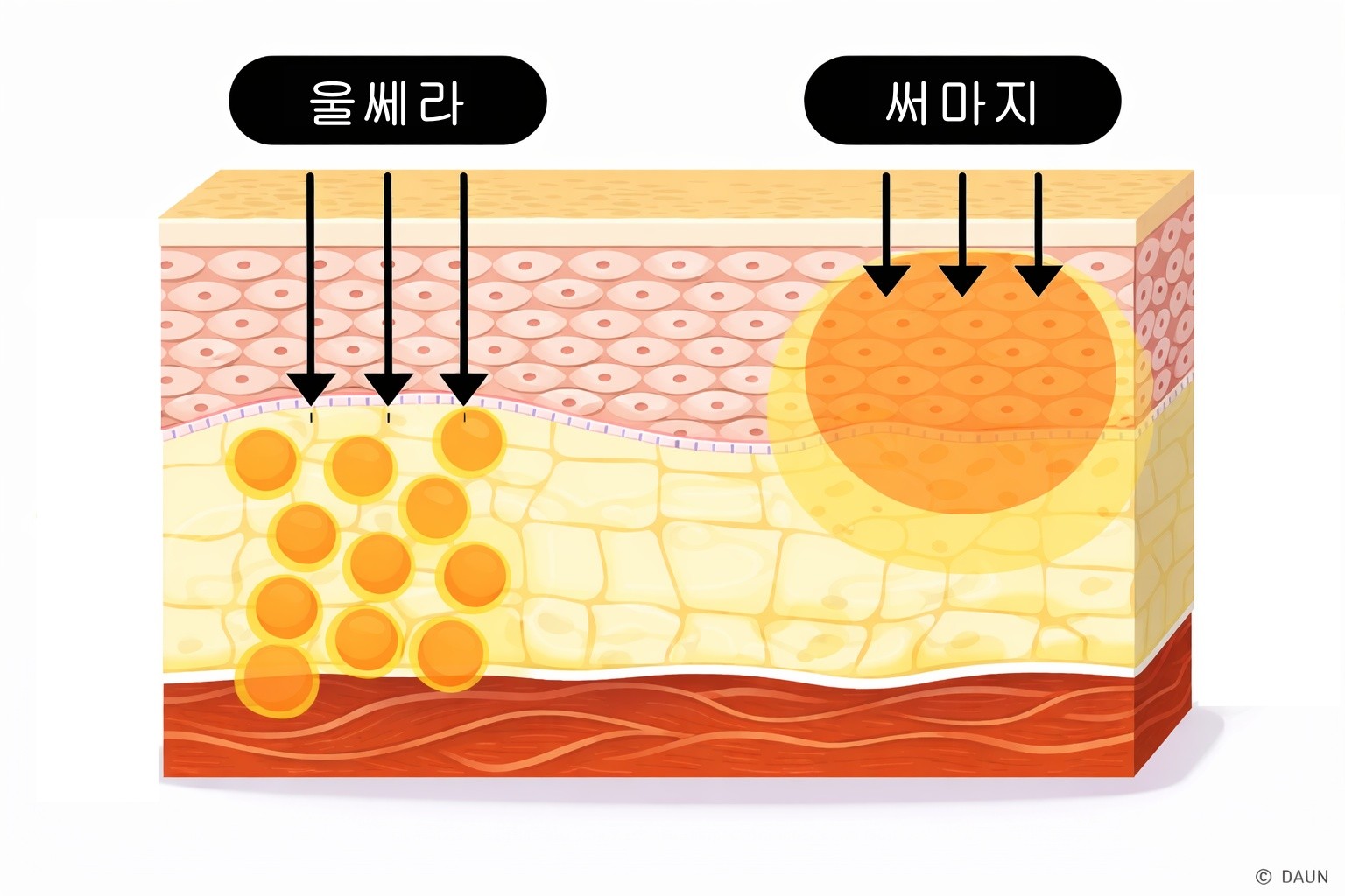 울쎄라 vs 써마지 차이 비교