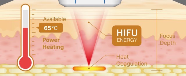 슈링크 효과 시기, 300샷과 같이 알아보기