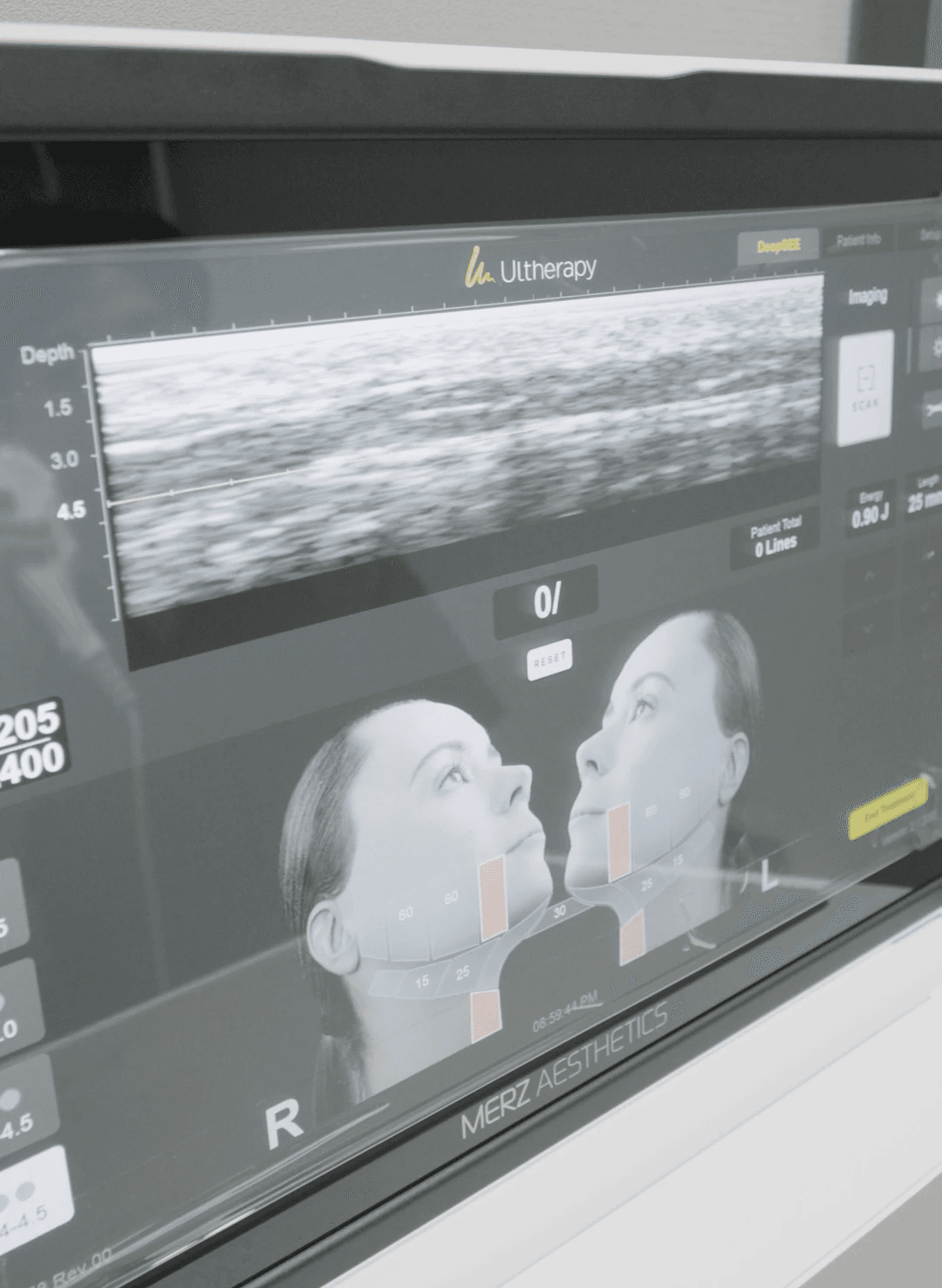 超声刀與Shurink效果差異比較