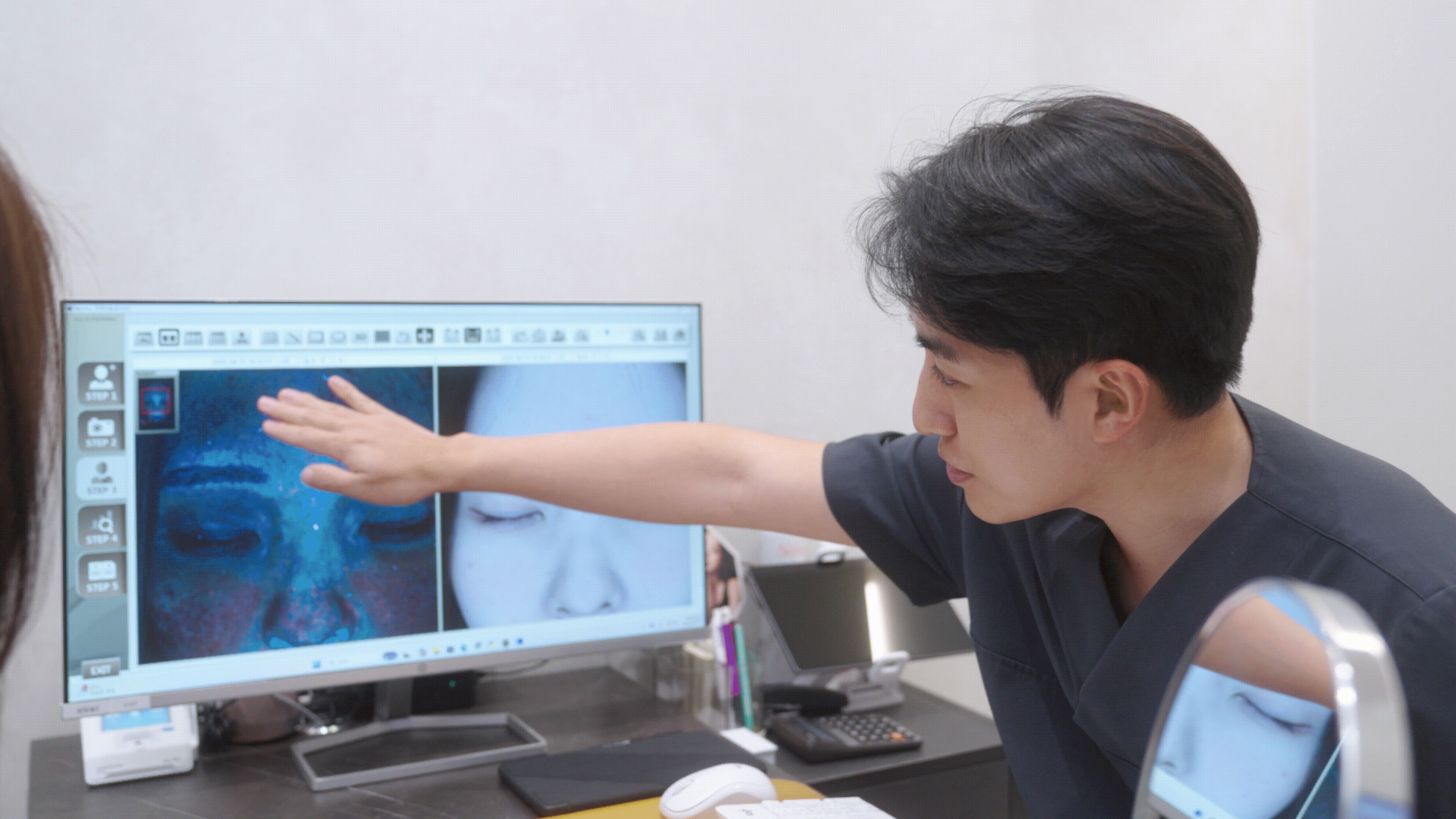 การกำจัดจุดด่างดำและฝ้าด้วย Pico Laser