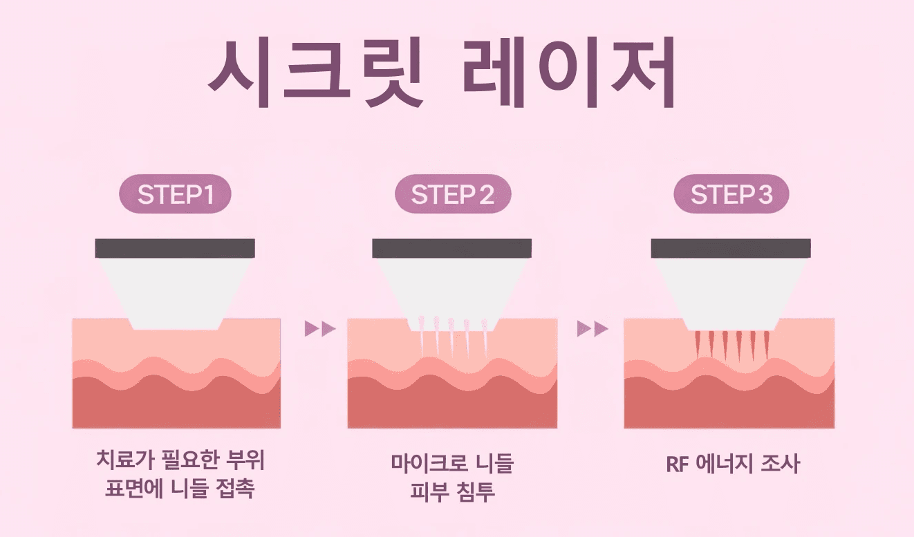 秘密雷射改善臉部毛孔收縮效果