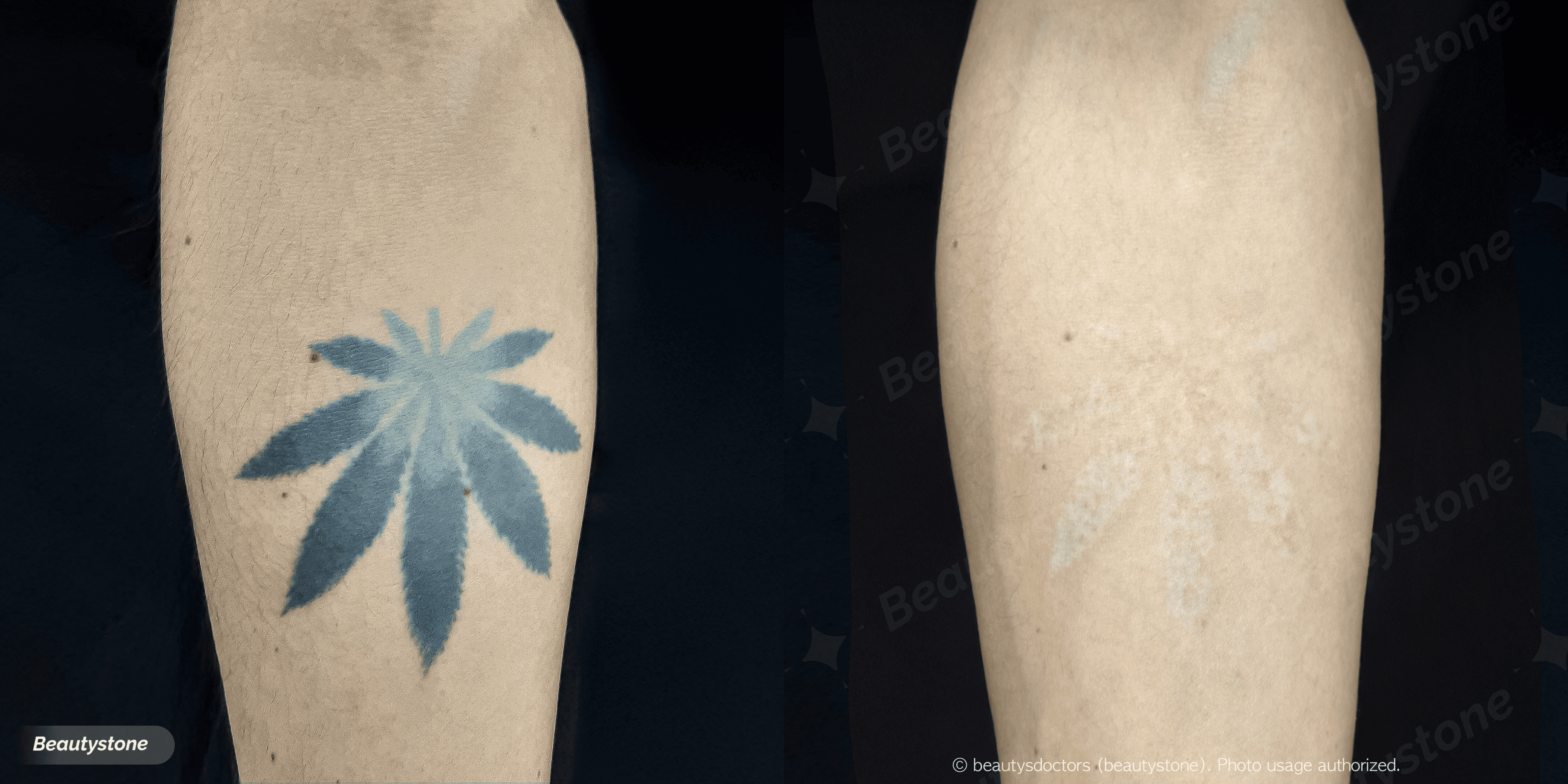 彩色刺青去除皮秒威，各顏色去除率誠實比較