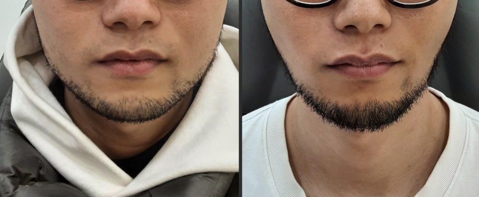 瘦脸針效果何時出現？＋臉部嘟嘟肉消除法