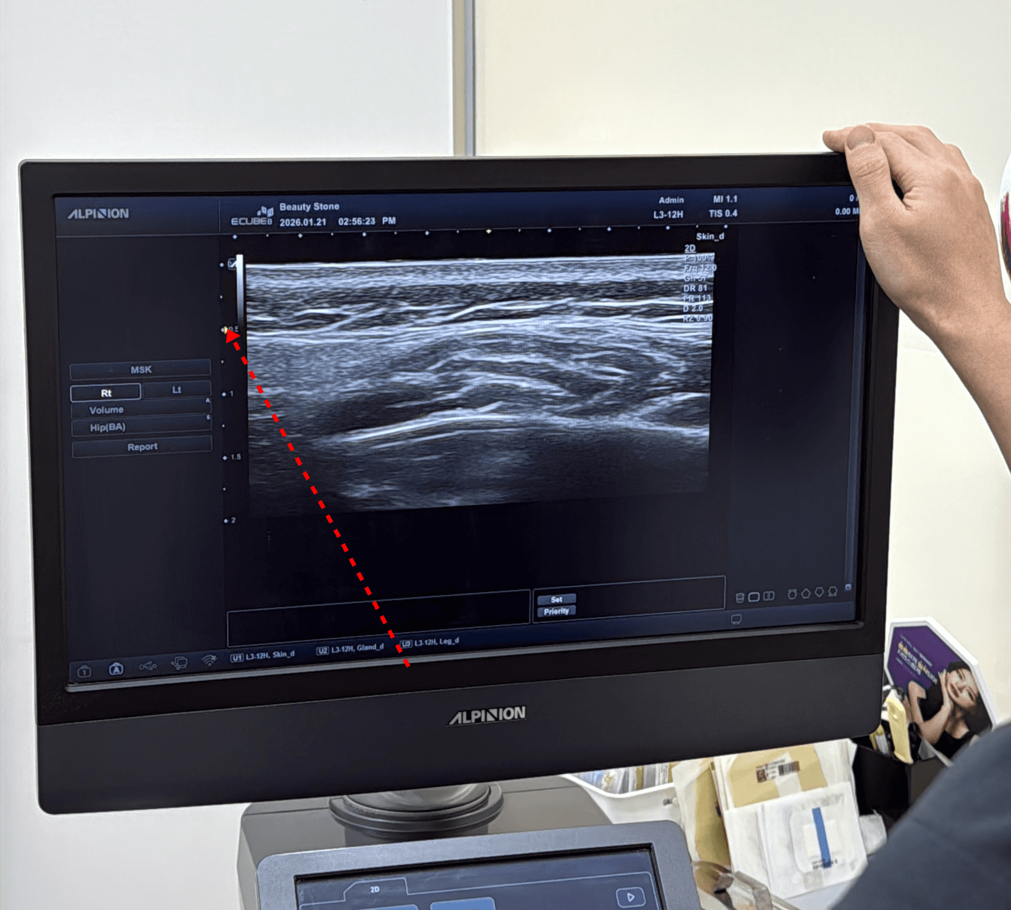 비싼 초음파기계로 피부두께를 재는 이유
