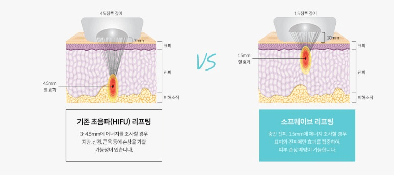 索夫波的價格、效果、疼痛感與真實心得