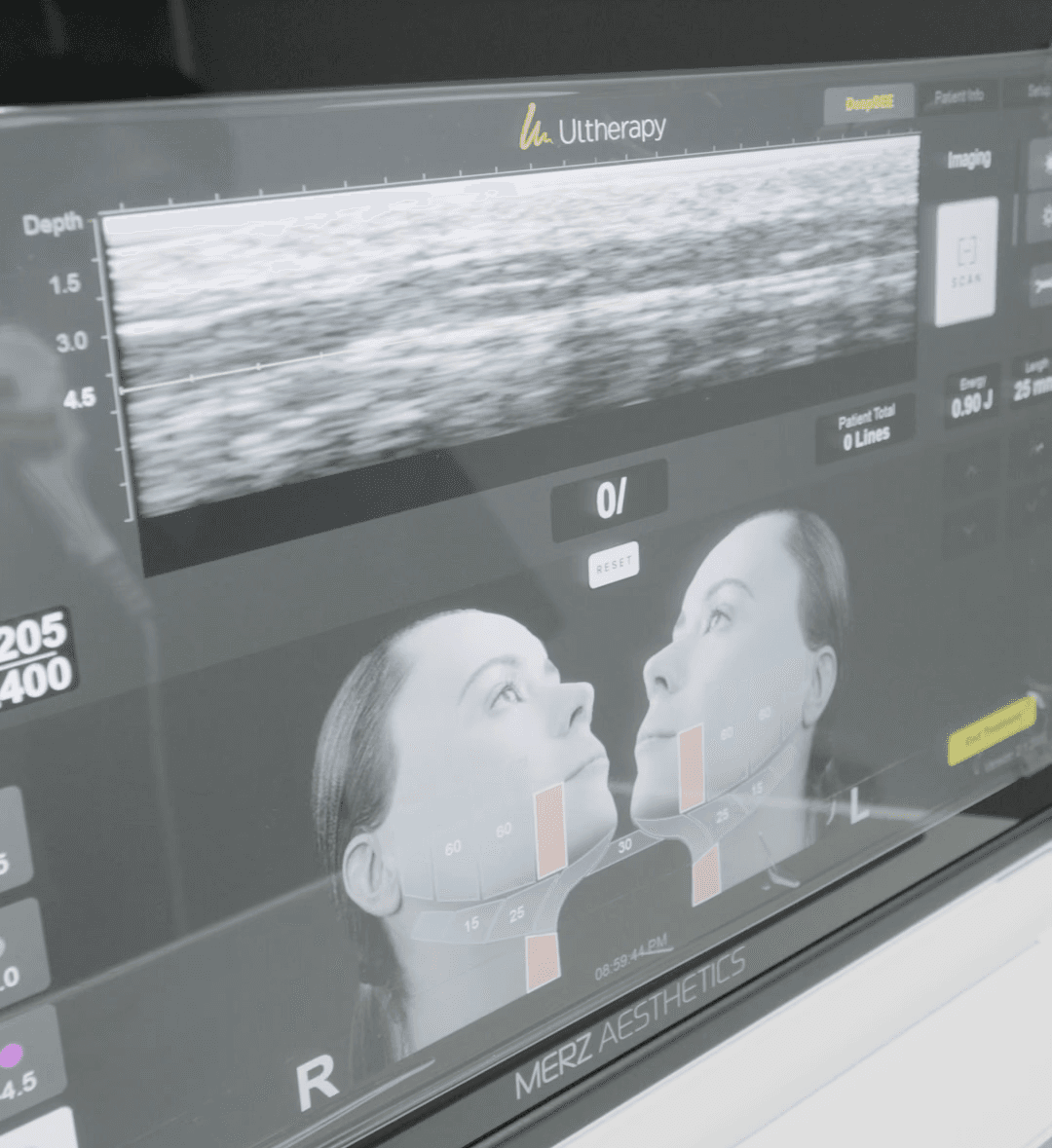 비싼 초음파기계로 피부두께를 재는 이유