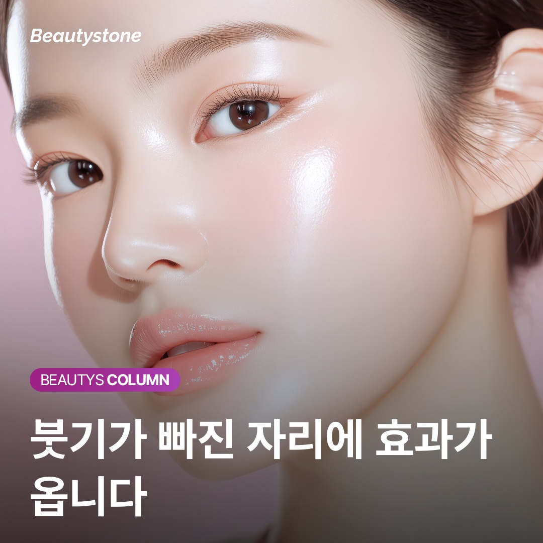 울쎄라 붓기 시술 후 경과