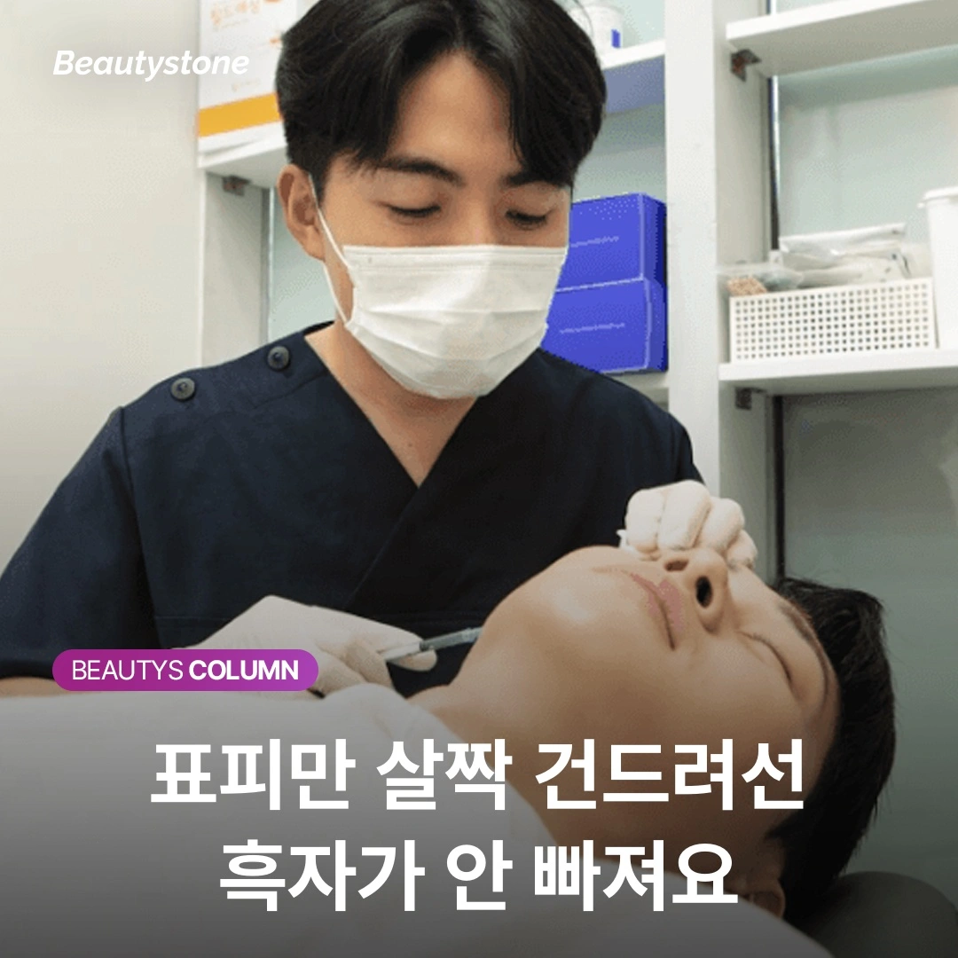 เลเซอร์ CO2 กำจัดฝ้าแดด — ทำไมต้องลึกถึงชั้นหนังแท้ส่วนบน?