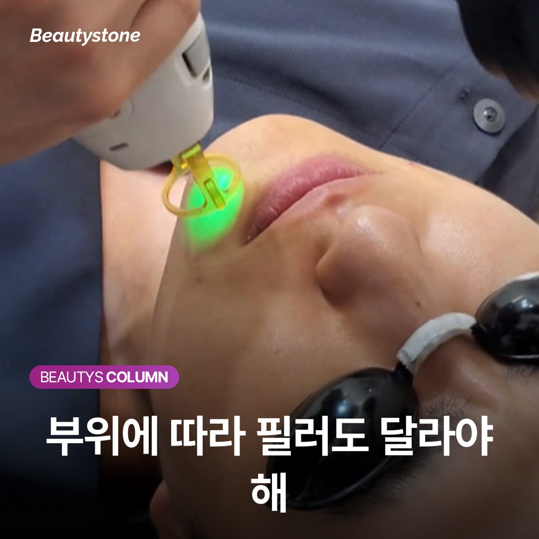 Different Areas Require Different Fillers