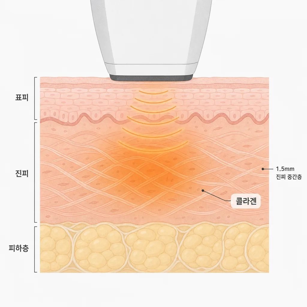 고주파 열이 닿는 진피층과 콜라겐
