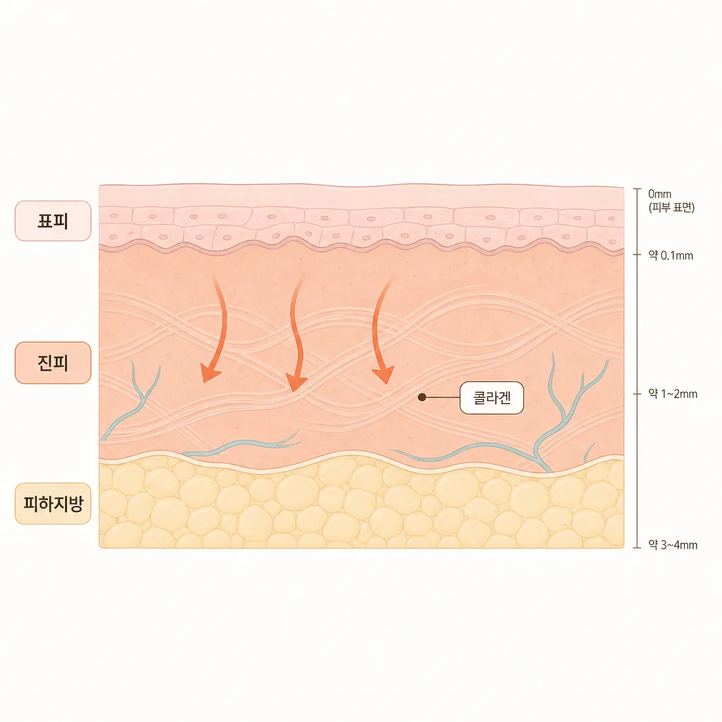 진피층의 콜라겐에 열이 전달되는 단면