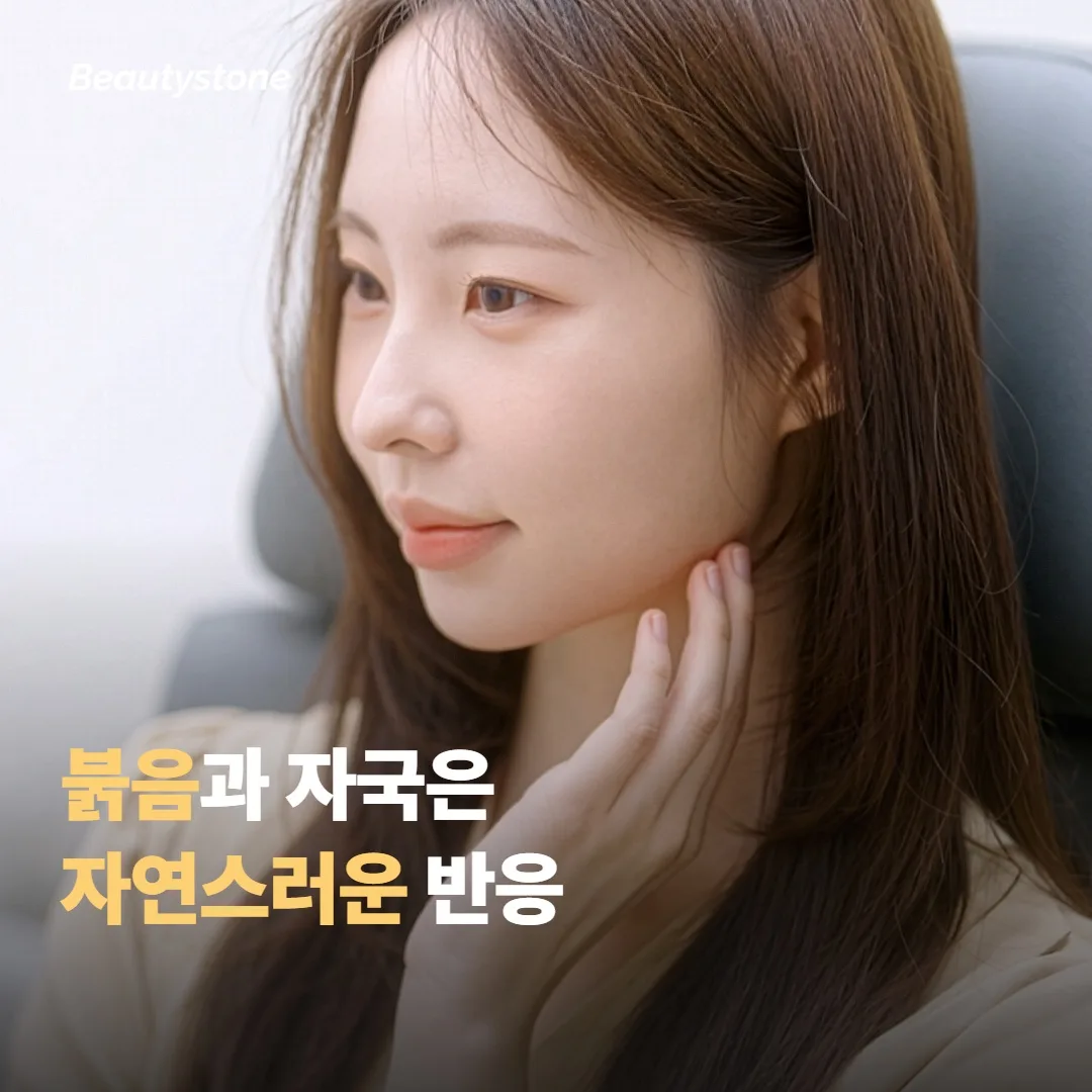 시크릿RF 직후 붉음과 자국이 생기는 건 자연스러운 반응이에요