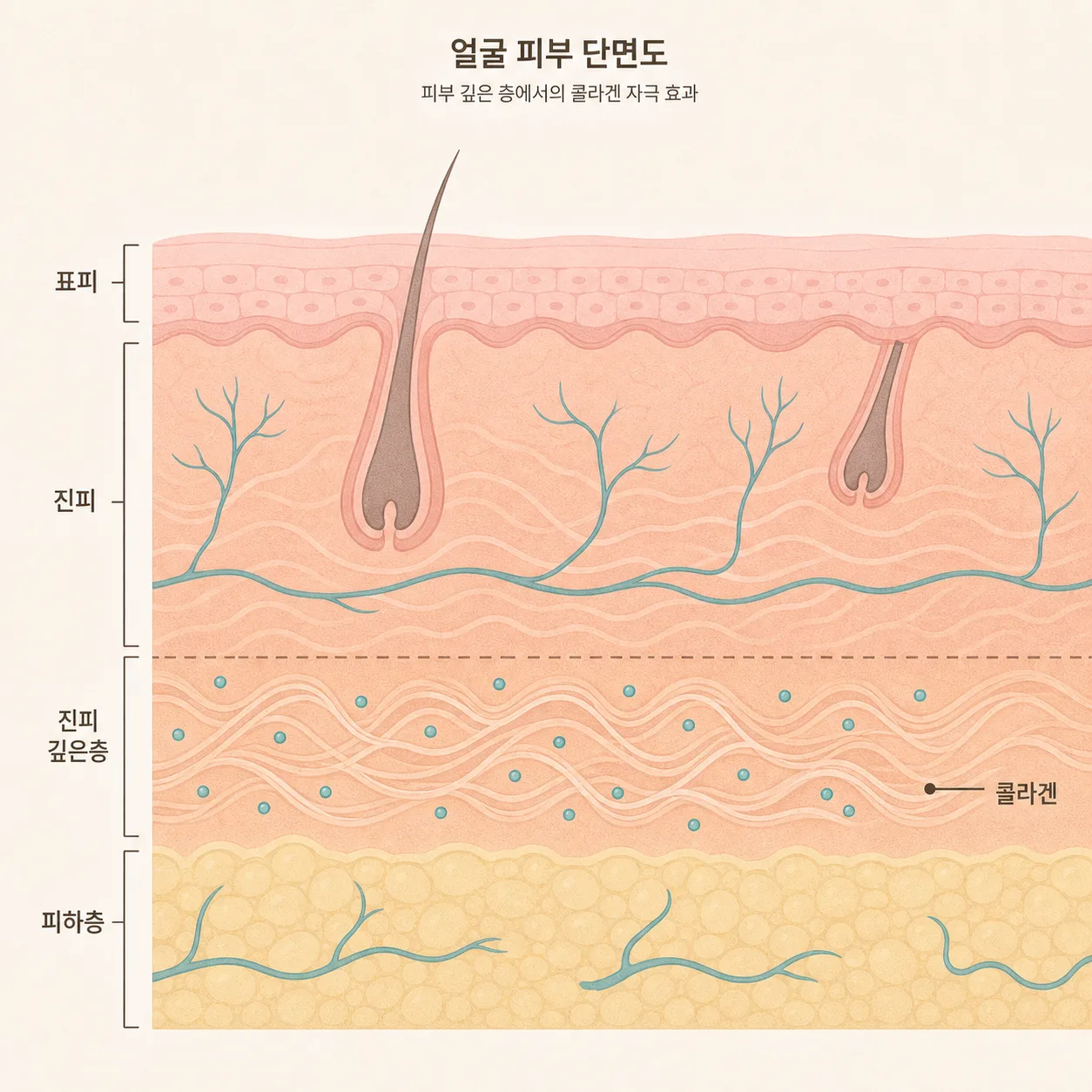 피하층에서 콜라겐 생성을 유도하는 모습