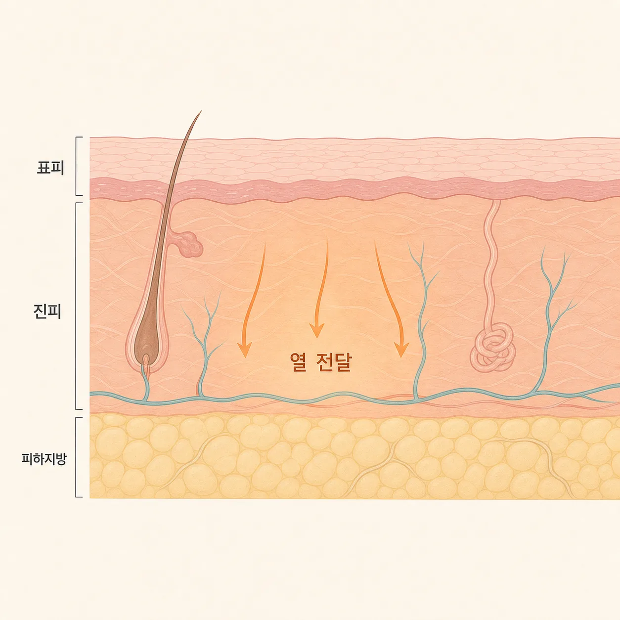 ภาพแสดงความร้อนจากคลื่นวิทยุ (RF) ที่ส่งผ่านไปยังชั้นหนังแท้
