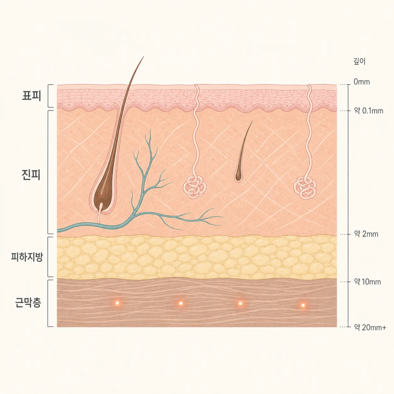초음파 에너지가 깊은 근막층에 모이는 모습