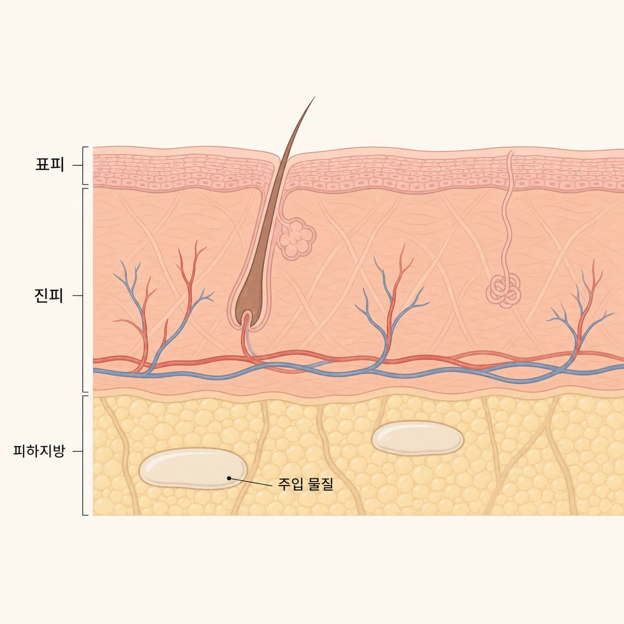 피하지방층에 자리잡는 주입 물질