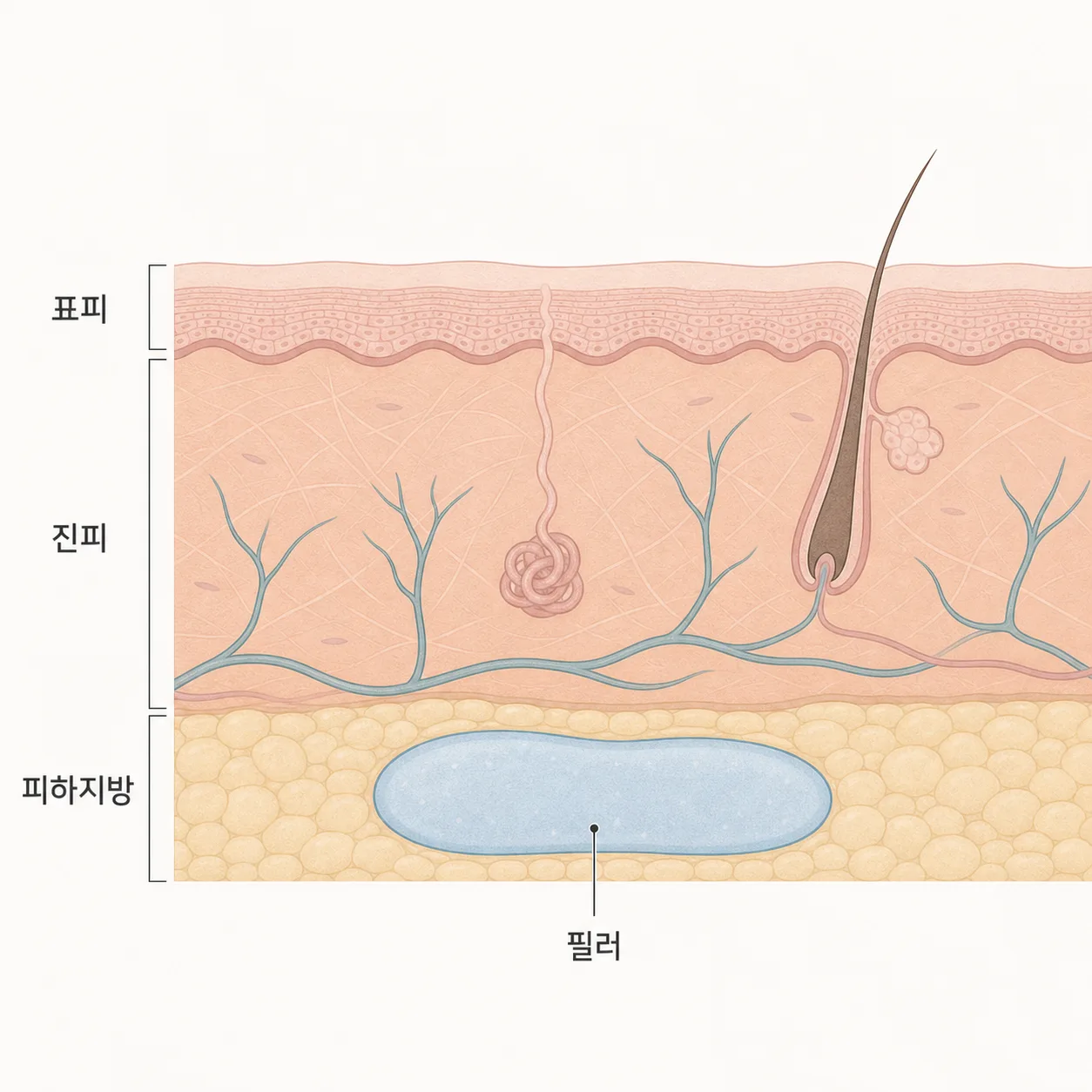 피부 아래 지방층에 자리 잡는 필러